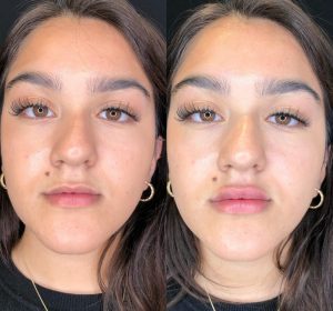 Front view of before and after lip fillers