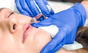 Thu Linh lip fillers scaled