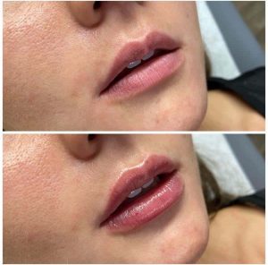 Lip-fillers-Before-and-After benefits