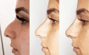 Nose job treatment