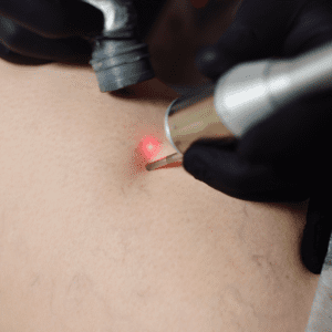 Image of our thread treatment procedure at Omniya