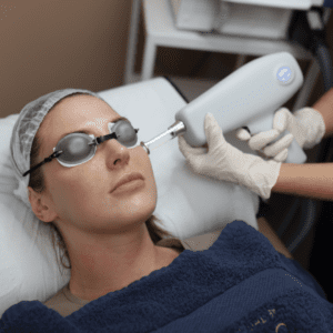 Treatment of Thread Veins in the face