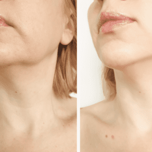 What-Is-The-Link-Between-Sagging-Skin-And-Morpheus8-Treatment-2