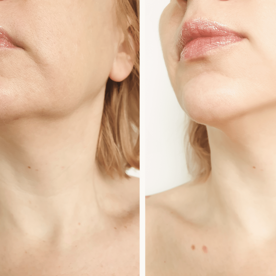 What-Is-The-Link-Between-Sagging-Skin-And-Morpheus8-Treatment-2