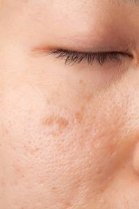 acne scarring treatment at Omniya