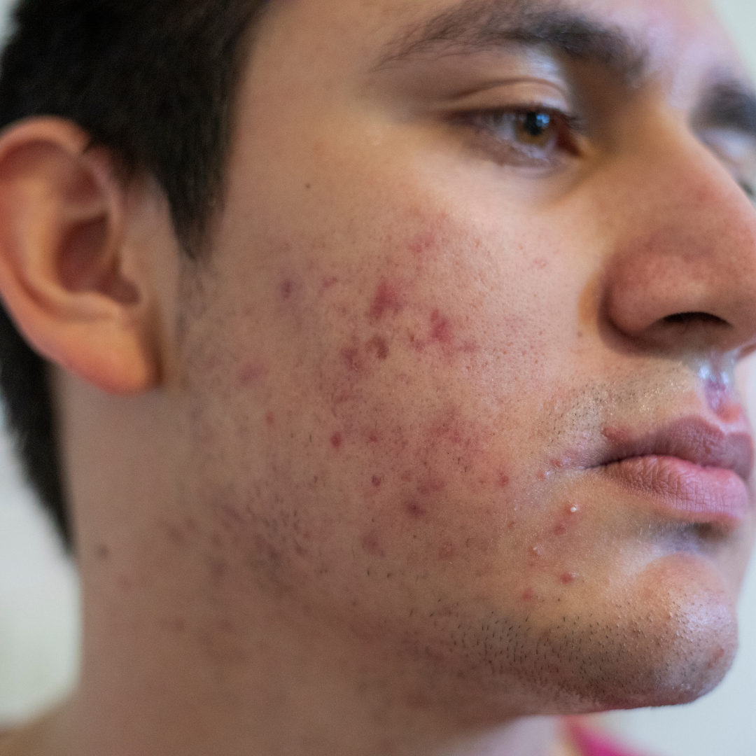 Acne on a mans face