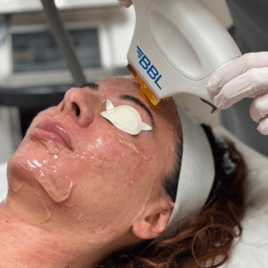 Close up of BBL treatment at Omniya during the process. bbl laser london, moxi laser, bbl laser, bbl and moxi, bbl moxi, bbl moxi london, bbl moxi laser, bbl hero london, bbl hero, bbl and moxi laser, bbl treatment, bbl facial, bbl facial London, moxi laser near me, bbl & moxi