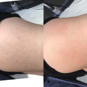 Thread vein reduction - before & after