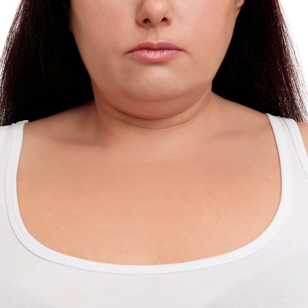 Double-chin-Causes-Symptoms-Treatments