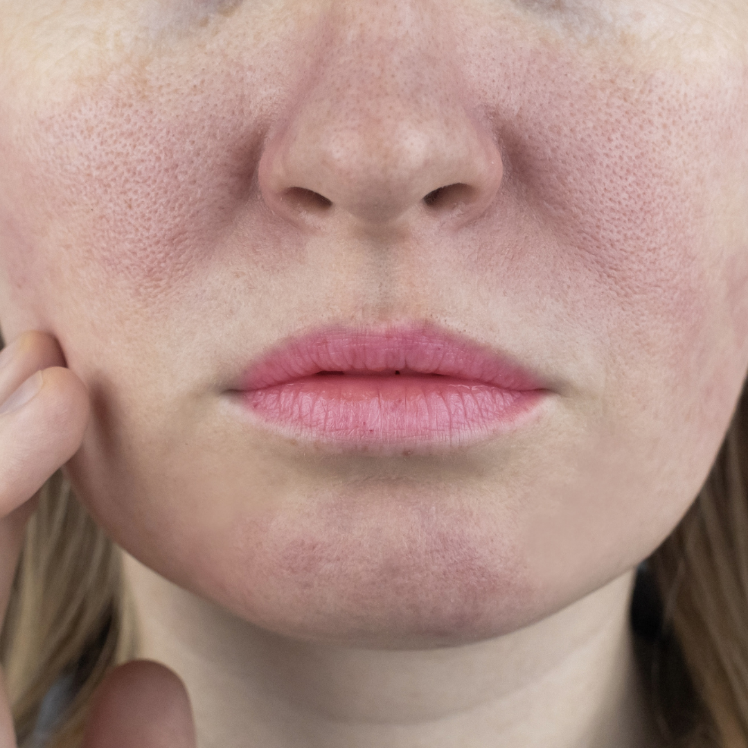 enlarged pores on a face