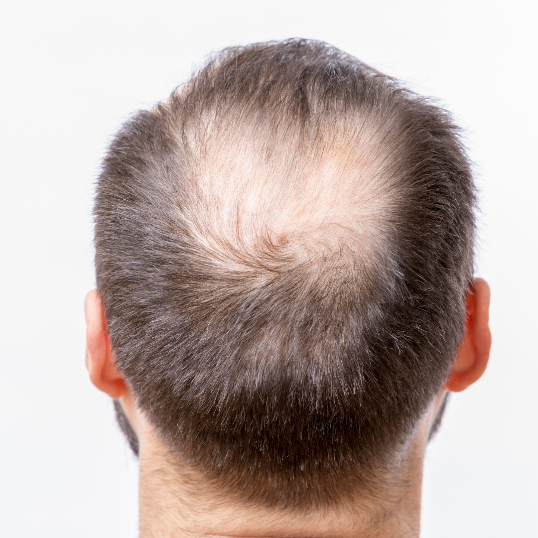 the back of a head showing hair loss