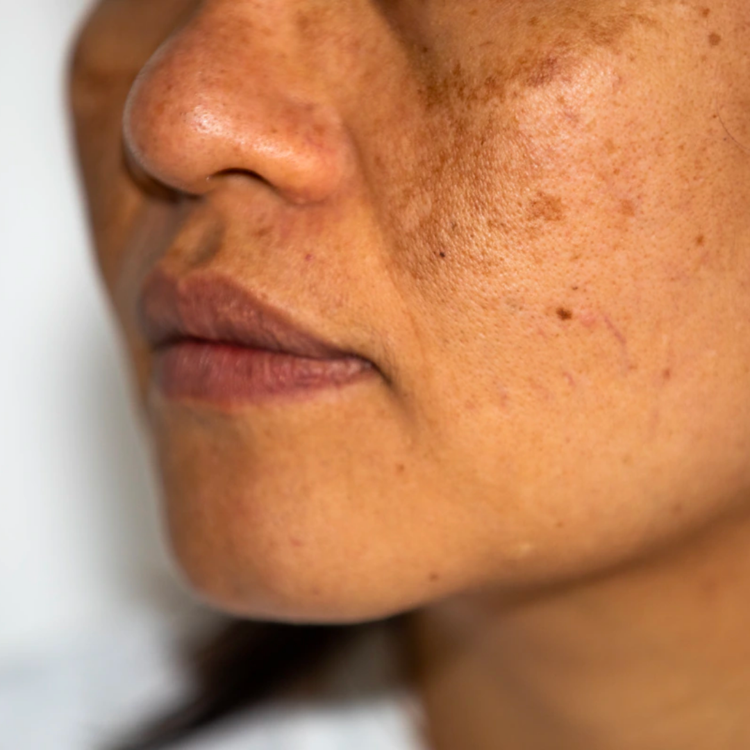 Hyperpigmentation on a face