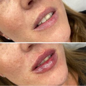 Lip fillers - before & after on a woman