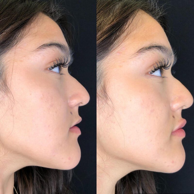 Lip fillers side view of before and after