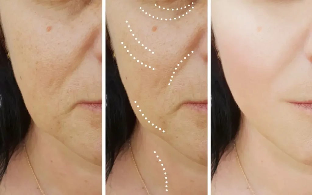 the process of an 8 point facelift