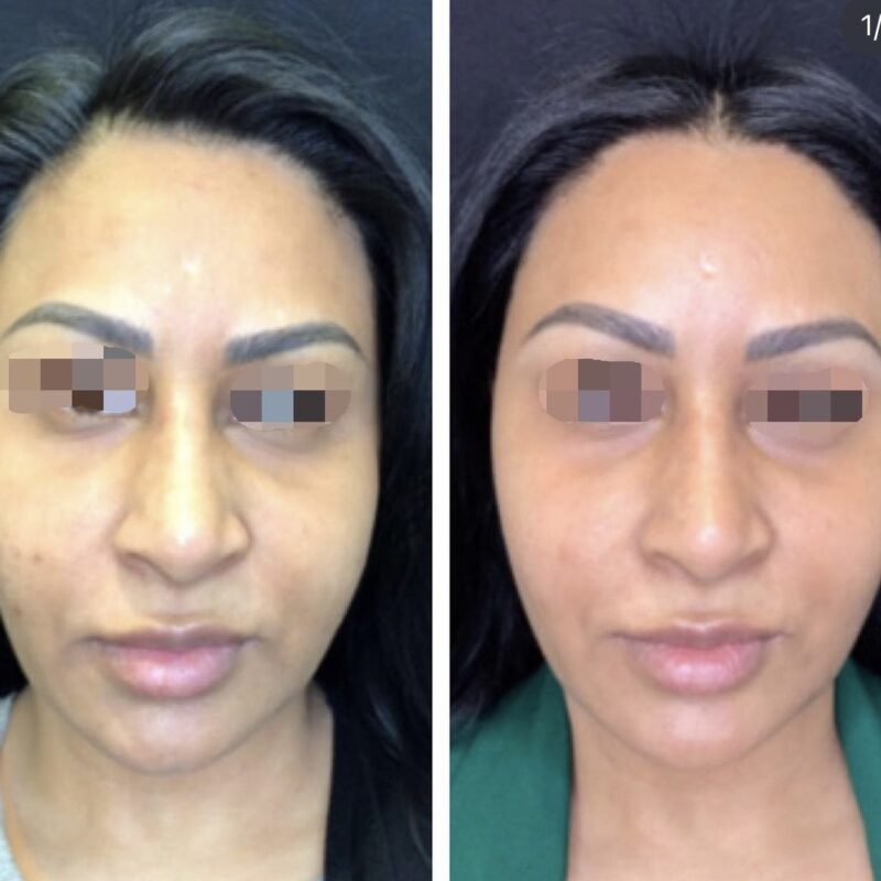 Morpheus8 before and after image