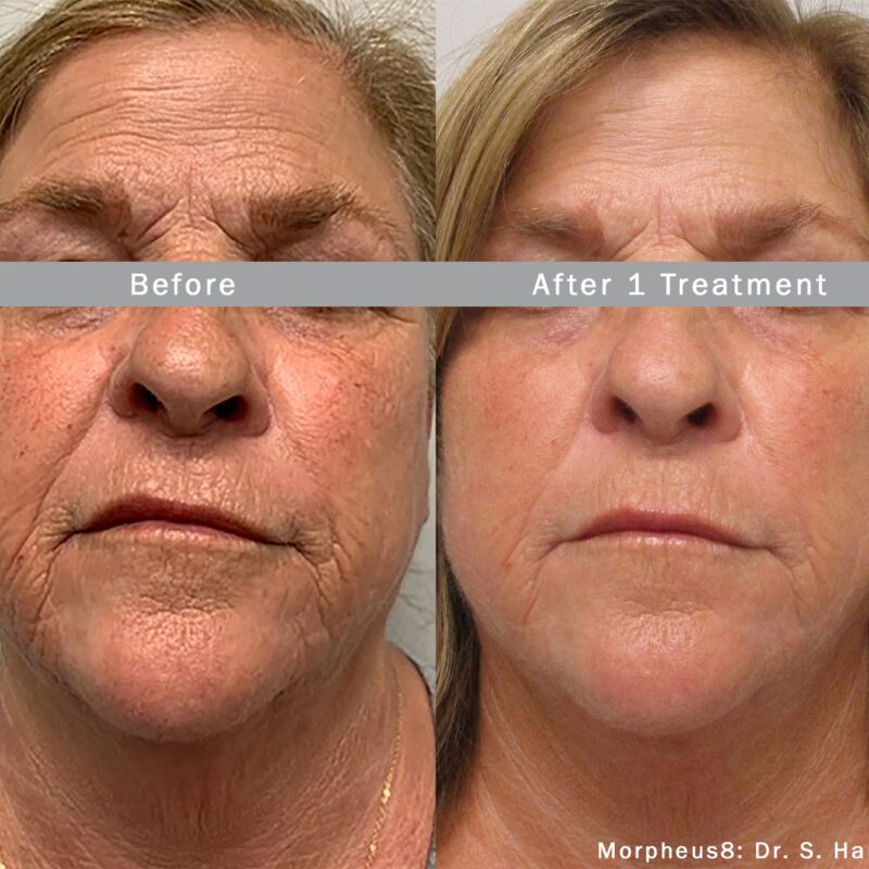 Morpheus8 treatment - before & after