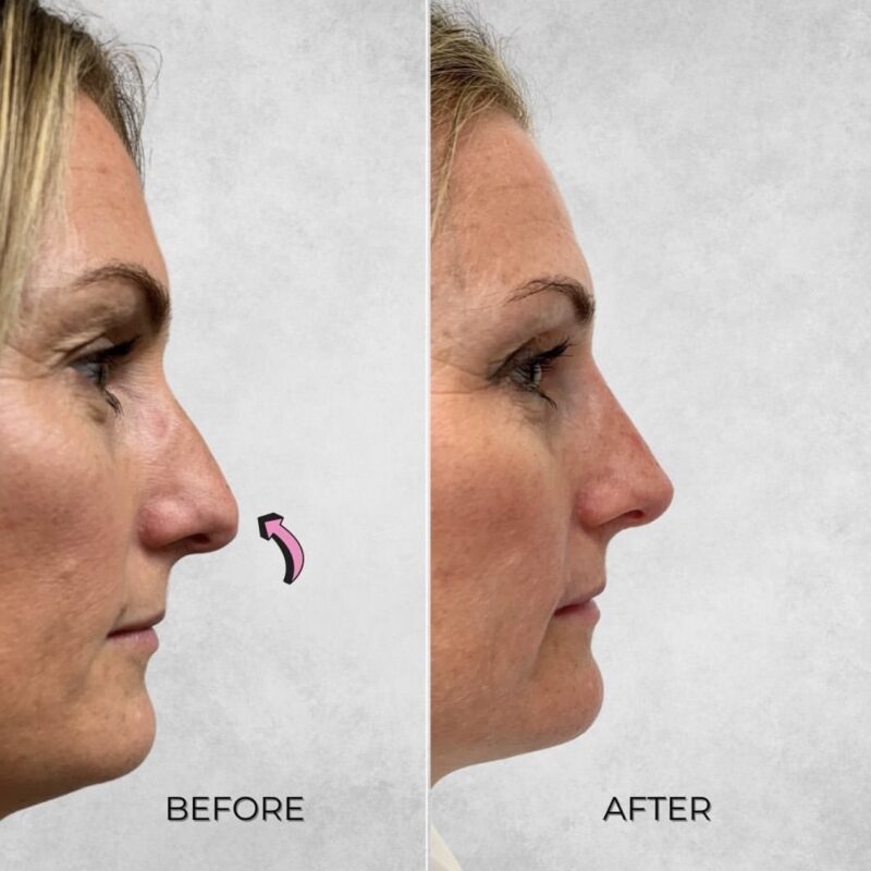 Non surgical nose job - before & after