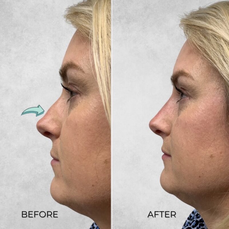 Before and after side profile of a woman after non surgical nose job treatment