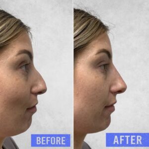 Before and after side by side of the non surgical treatment we offer at Omniya