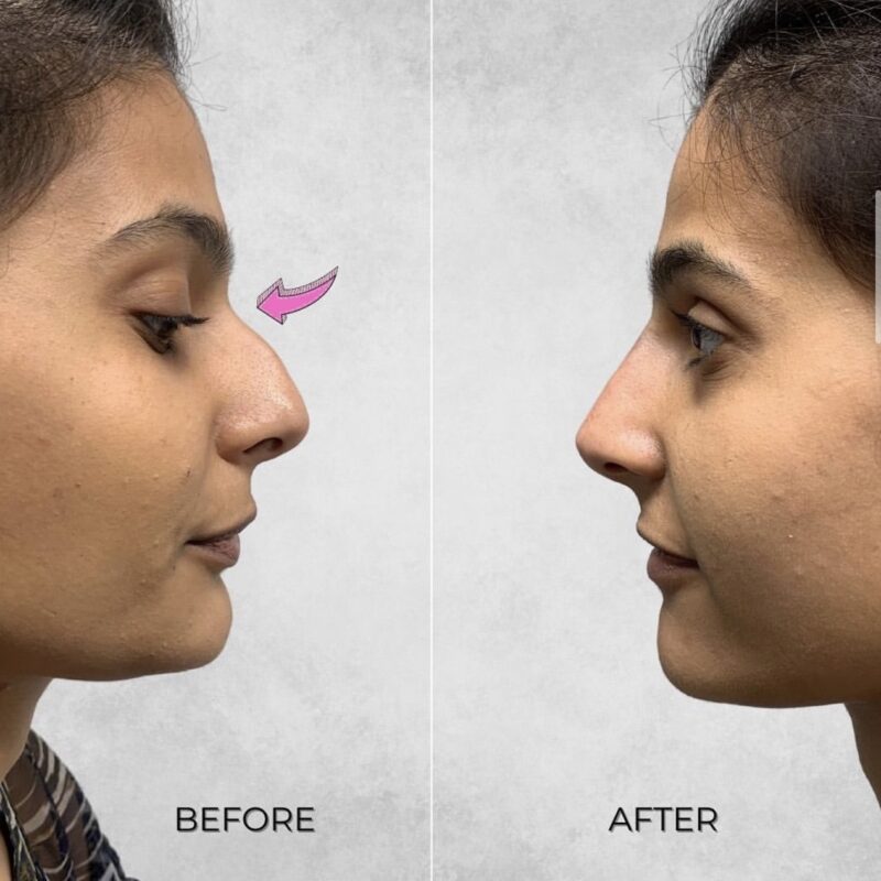 Before and after image of a woman who had the non surgical nose job treatment at Omniya