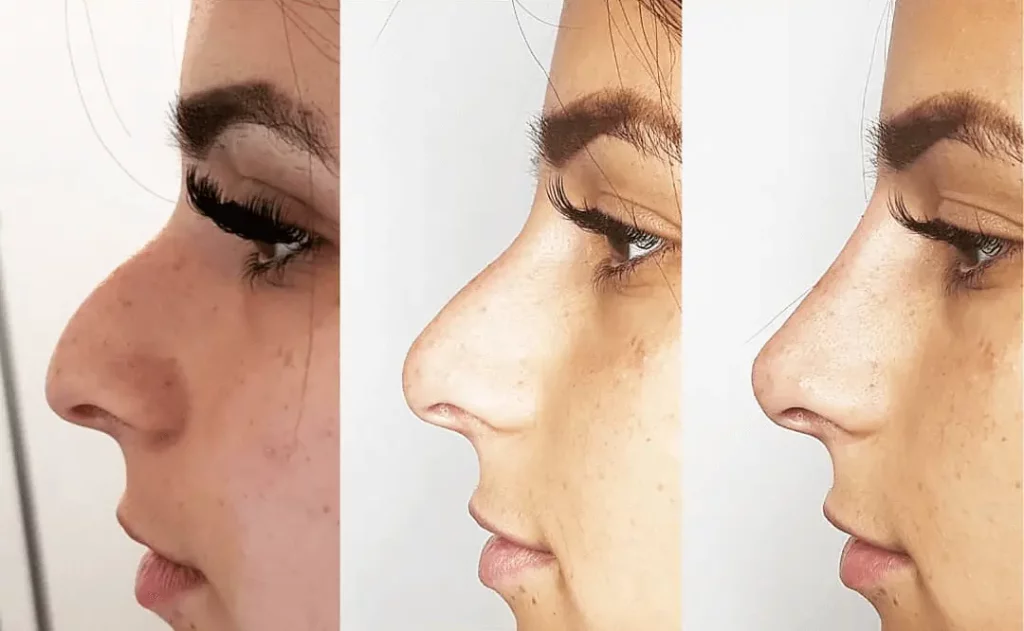 The before, during and after of a non surgical nose job