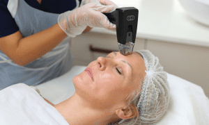 morpheus 8 treatment on a forehead