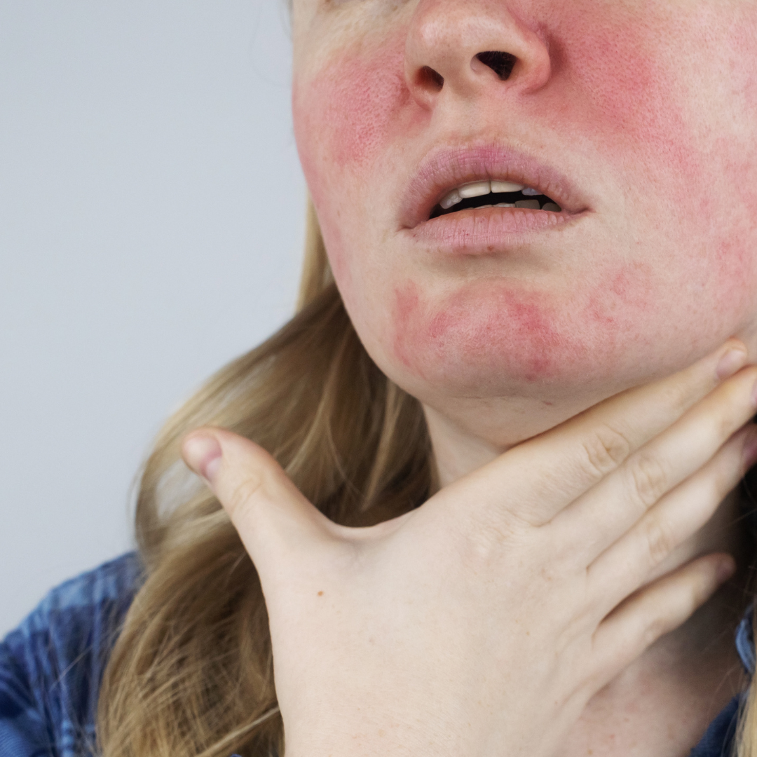 Rosacea-Causes-Symptoms-Treatments
