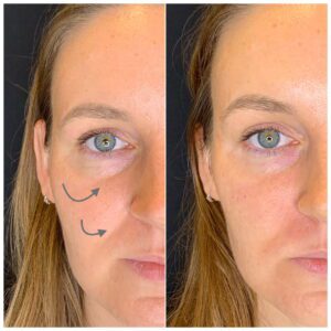 Tear trough fillers - before & after