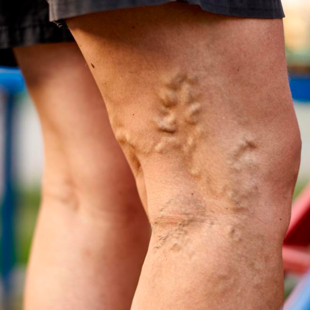 Thread-Veins-Causes-Symptoms-Treatments