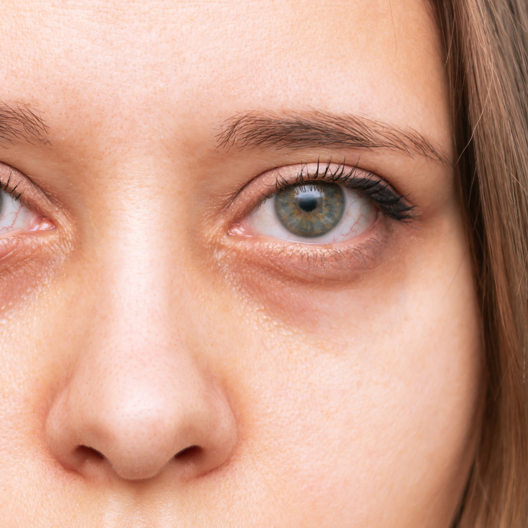 dark circles under a persons eye