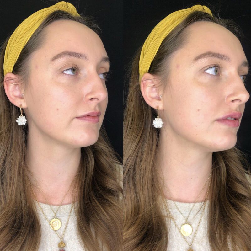 Lip fillers - before & after side view