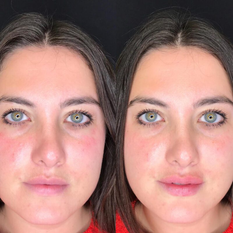 Lip fillers - before & after full face results