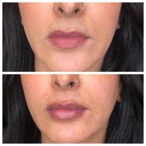 Lip fillers - before & after lip close up