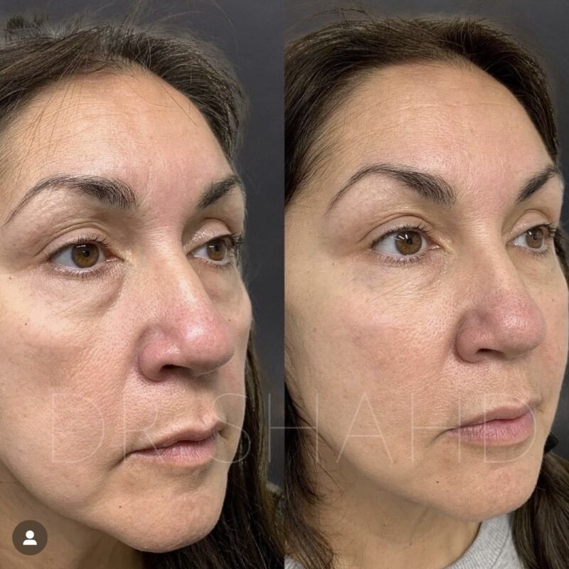 A side by side comparison of the before and after of a tear through filler treatment