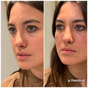 Before and after image of tear through treatment