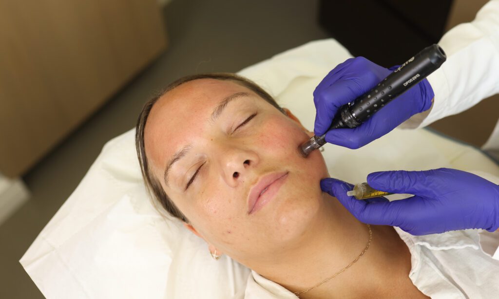 dermapen microneedling treatment