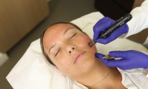 dermapen microneedling treatment