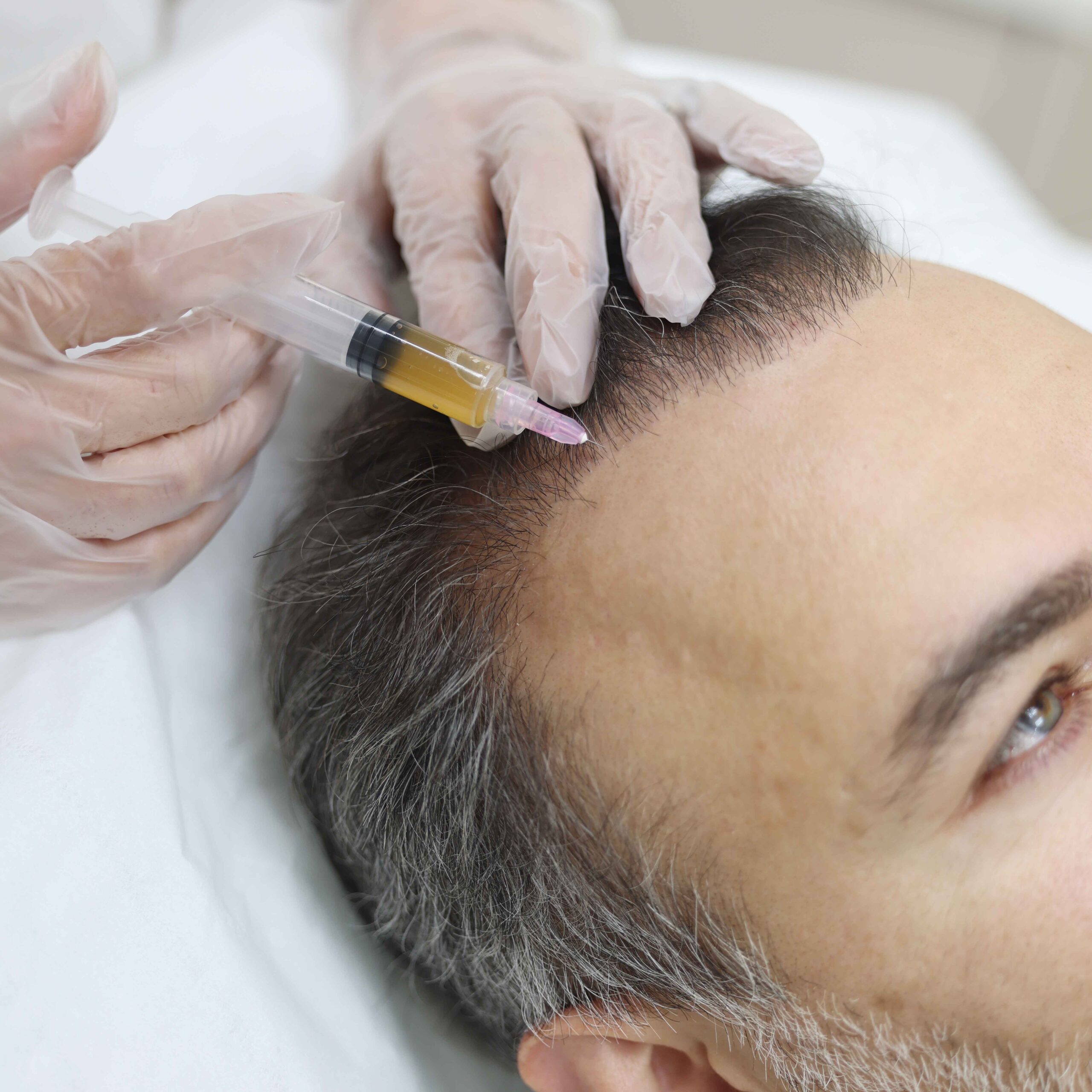 Hair PRP treatment