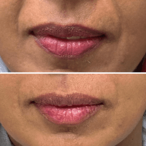 lip fillers before and after