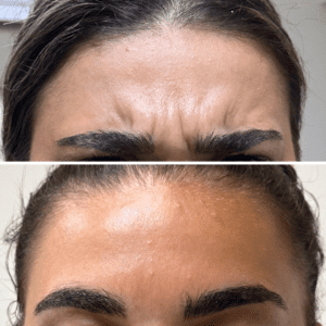 forehead fillers - before & after