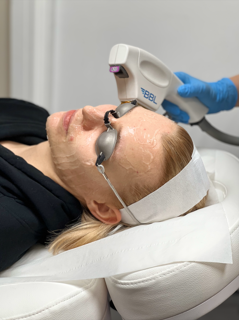 Patient having BBL treatment at Omniya Clinic, London