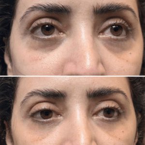 tear trough fillers - before and after