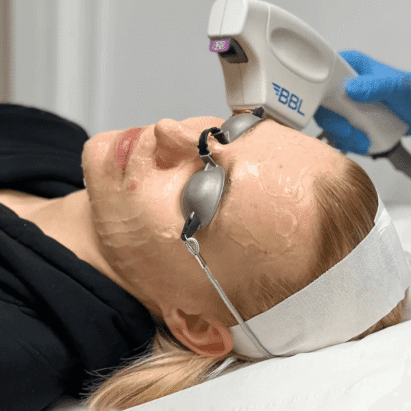 BBL Moxi Laser treatment