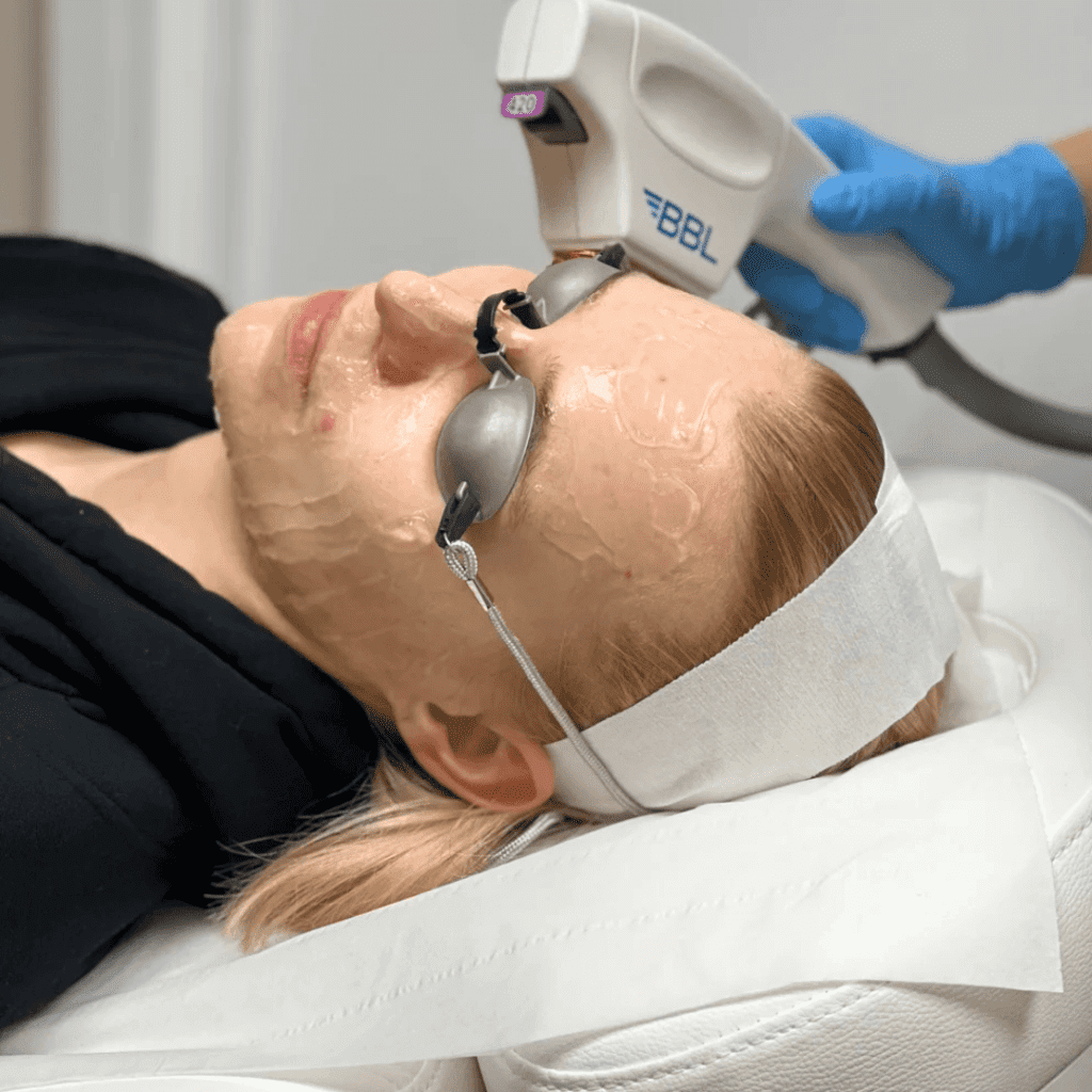 HydraLite Facial BBL and Hydrafacial