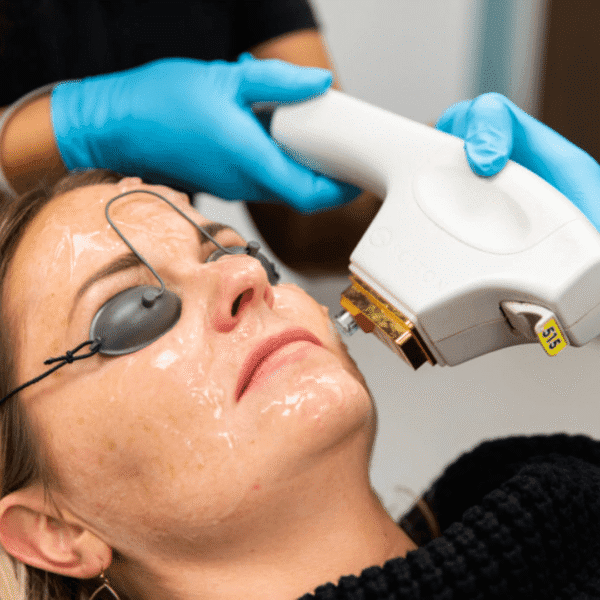 skintyte treatment bbl laser moxi facial