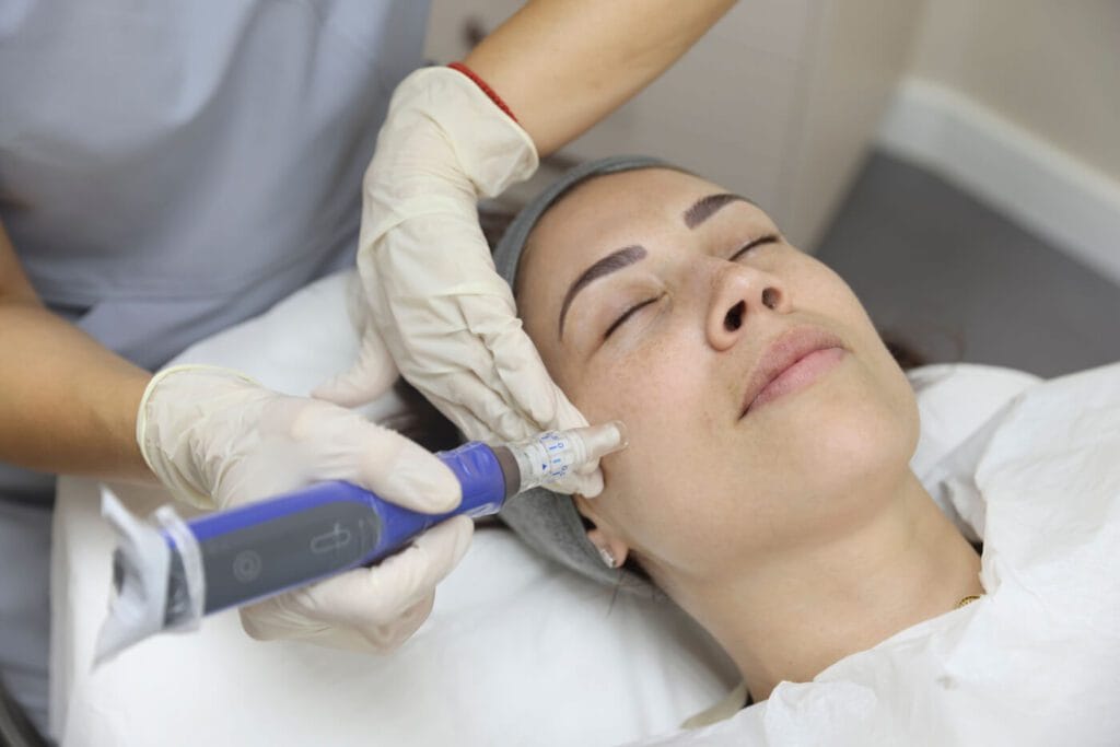 microneedling and exosomes